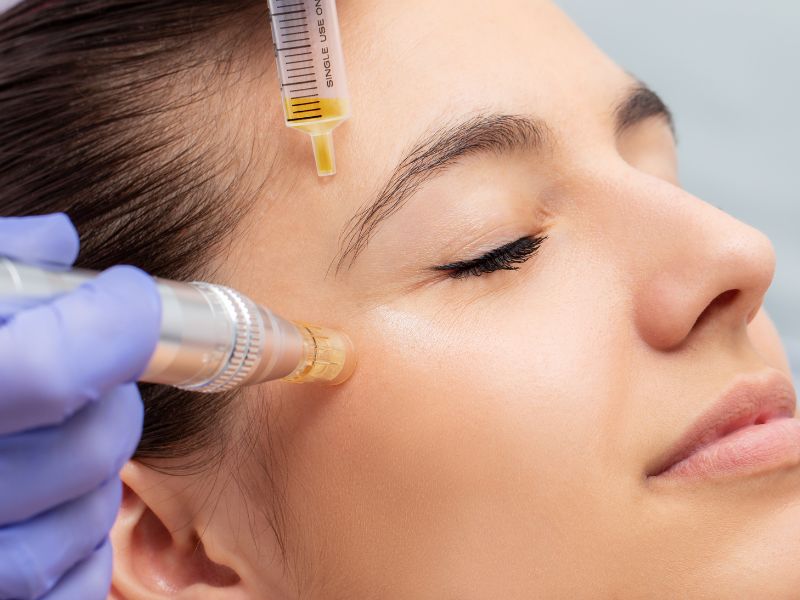 micro needling